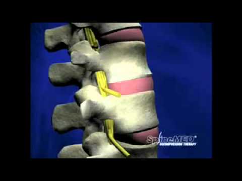Das Knie Spacer Rückenschmerzen Behandlung und Gymnastik