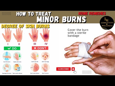 Home Remedies for Burn Relief | How To Treat Burn Skin | Burn Treatment Remedies