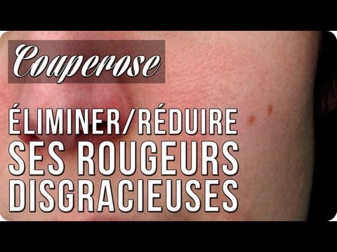 comment traiter la couperose sur le visage