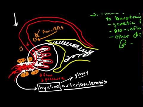 Ruptur der Aorta mit hypertensiven Krise Was mit dem Angriff von Hypertonie zu tun