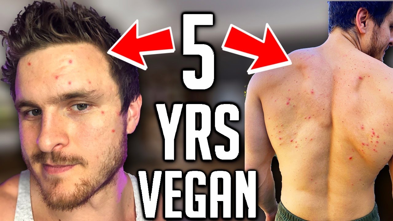 Veganism Does NOT Clear Acne (IT MAKES IT WORSE)