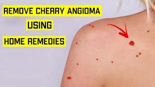 How To Get Rid of Cherry Angioma Naturally || Top 5 Home Remedies for Cherry Angiomas (Red Moles)