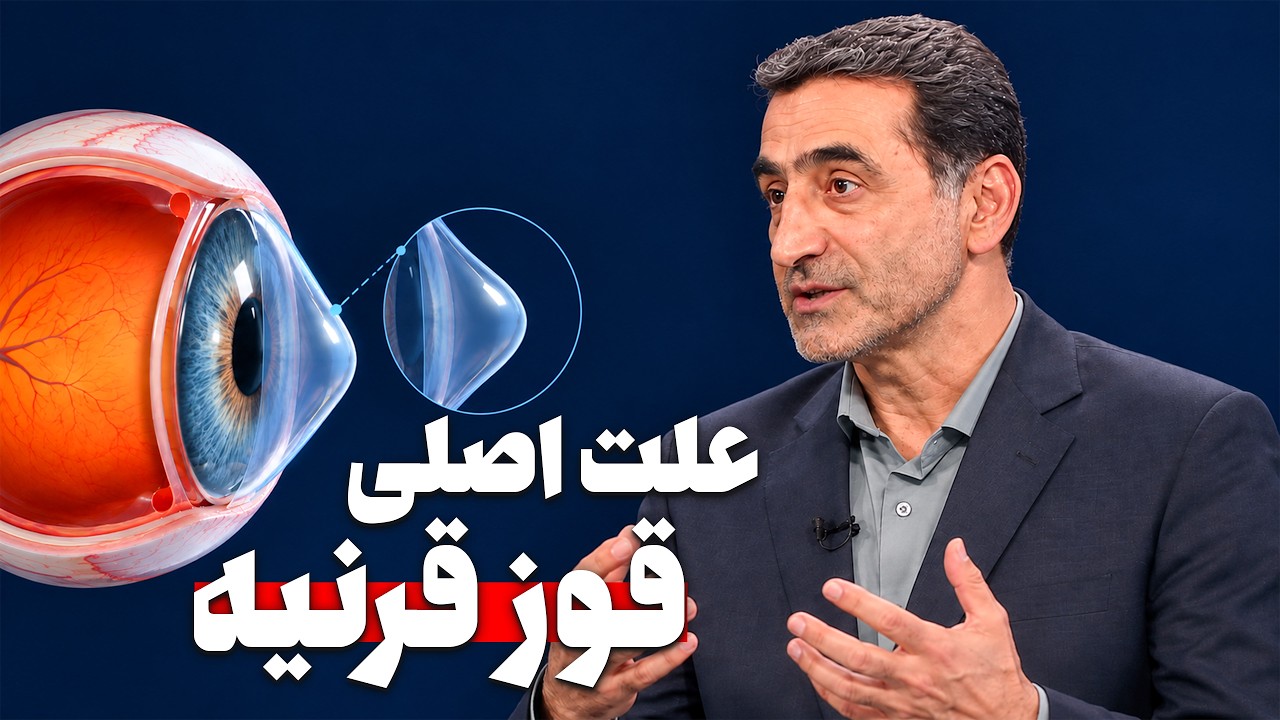 علت اصلی قوز قرنیه چیست؟ / خطرات مالش چشم و راه‌های جلوگیری از پیشرفت آن