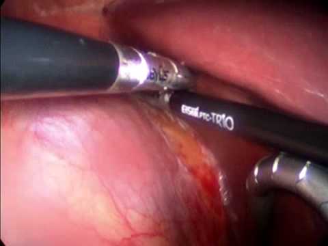 Right Minimally Invasive Adrenal Gland Removal With EnSeal Technique 