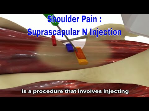 Banish Shoulder Pain With A Suprascapular Nerve Injection!