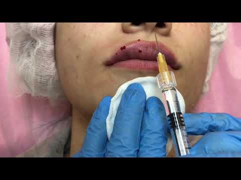 Увеличение губ:папоротниковая и парижская техника. 1ml. Нижняя губа.