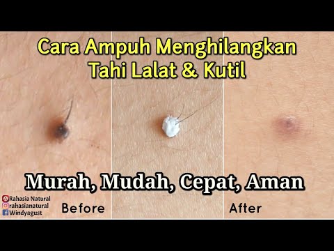 CARA MENGHILANGKAN TAHI LALAT DI WAJAH / CARA CEPAT MENGHILANGKAN TAHI LALAT TANPA SAKIT