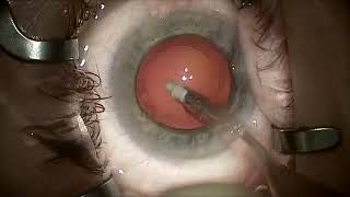 Cataract Surgery   SD 480p