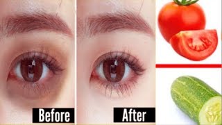 How to remove dark circles naturally overnight
