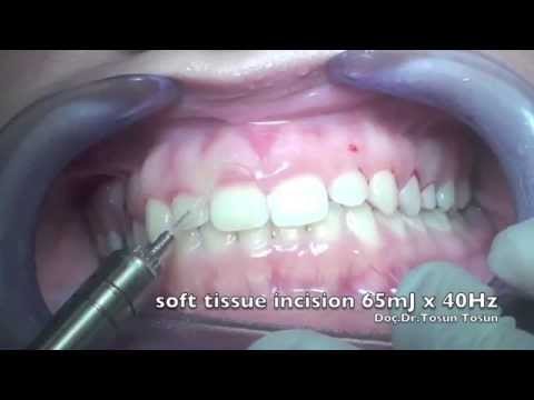 download lagu mp3 mp4 Gum Removal, download lagu Gum Removal gratis, unduh video klip Gum Removal