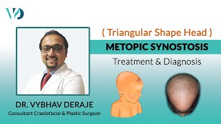 What is Metopic CraniosynostosisHow is it diagnosed & treaated - Dr. Vybhav Deraje|Aesthetica Veda