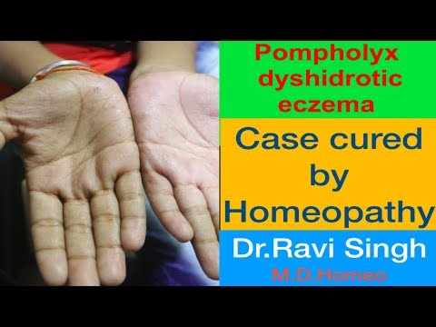 Pompholyx or Dyshidrotic Eczema Homoeopathic Cured Case