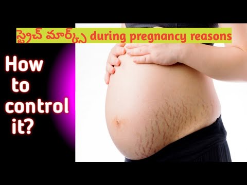 why stretch marks appear in pregnancy/how to avoid it/Telugu
