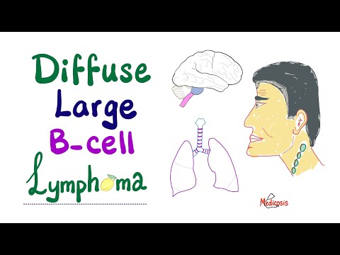 Diffuse Large B-Cell Lymphoma (DLBCL) - Aggressive  B-Cell Neoplasm - Non-Hodgkin’s Lymphoma