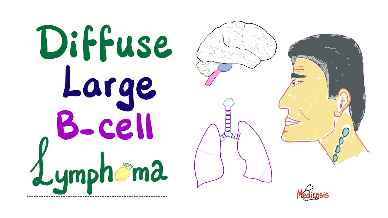 Diffuse Large B-Cell Lymphoma (DLBCL) | Aggressive B-Cell Non-Hodgkin’s Lymphoma - YouTube