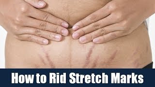 How to Rid Stretch Marks