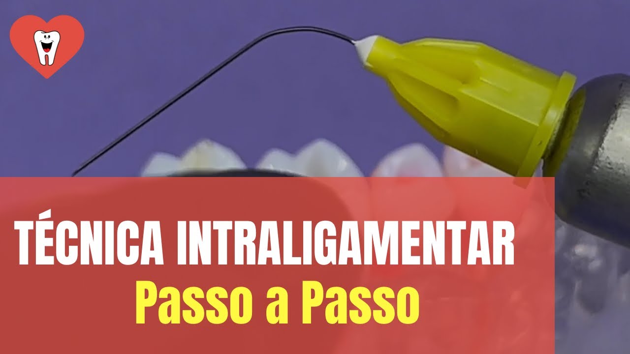 ANESTESIA INTRALIGAMENTAR- PASSO A PASSO DETALHADO