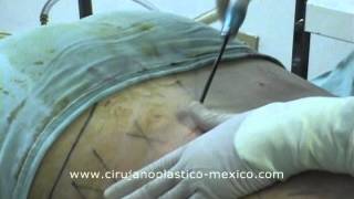 Liposuccion de Abdomen y Flancos (cintura)