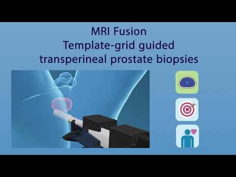Discover Vector - Fujifilm's new patient friendly electro-magnetic prostate biopsy