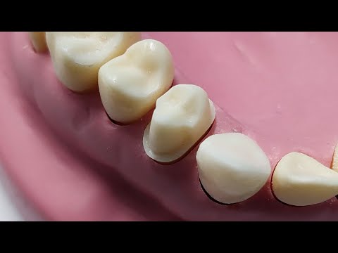 ازاى تعمل "Reduction for Veneered crown preparation (PFM wing  preparation upper 4)