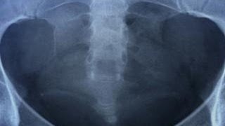 Morning Rounds: What's best for your bones?