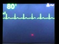 Nonsustained VT Wmv