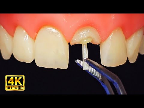 Satisfying Rebuild of a Broken Front Tooth with Post & Crown!