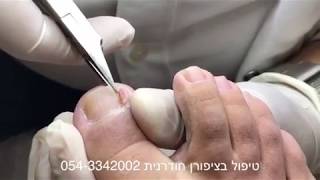 טיפול בציפורן חודרנית בני ברק