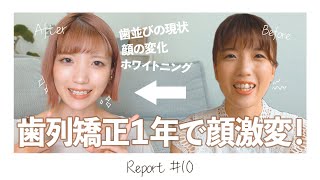歯 の 矯正 ビフォー アフター Watch Hd Mp4 Videos Download Free