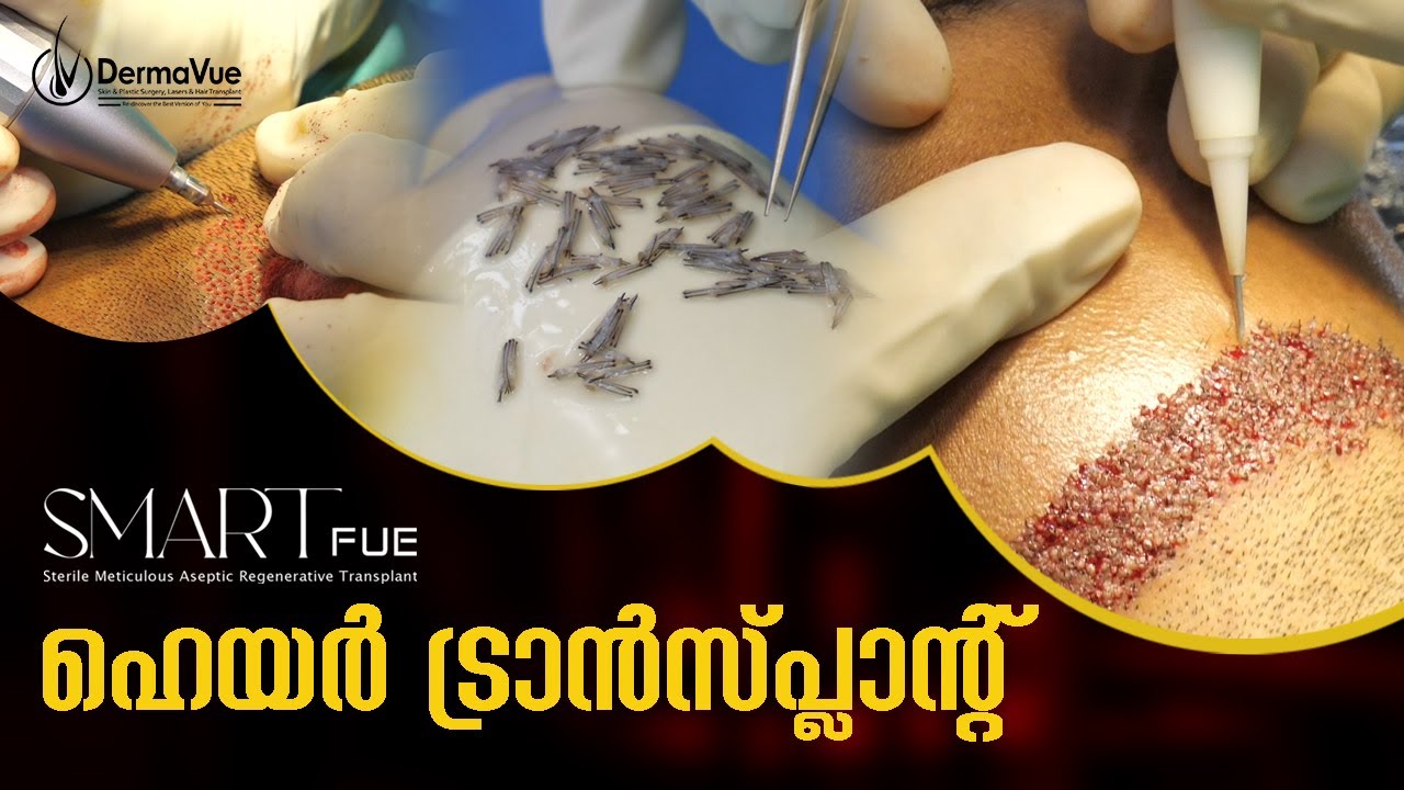 SMART FUE Hair Transplant Procedure at DermaVue Kerala