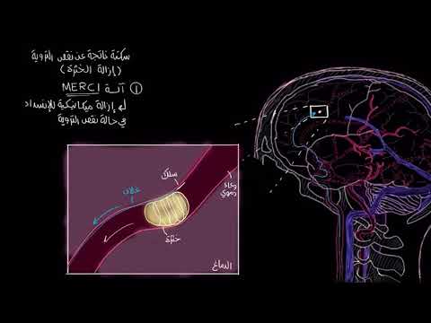 الصفوف المتقدمة الأحياء أمراض الجهاز الدوري علاج السكتة الدماغية بالتدخلات الجراحية