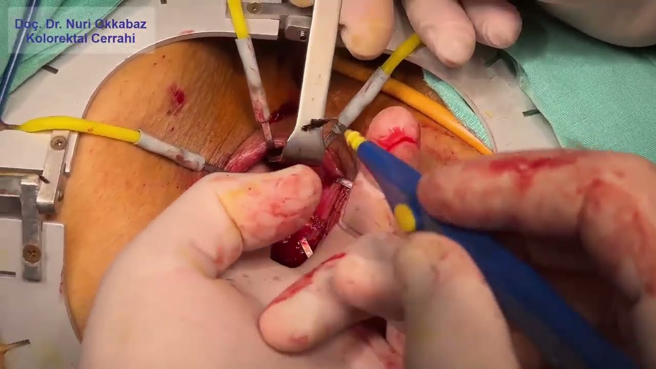 Stoma-Free Rectal Surgery (Intersphincteric Resection)