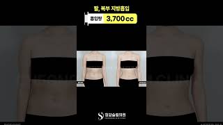 지방흡입, 이렇게까지 바뀔 수 있어?