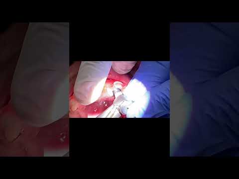 Fractura de diente, implante dental en Cali, Colombia