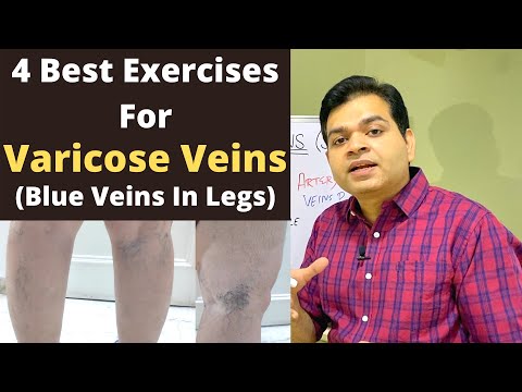 venous stasis edema treatment