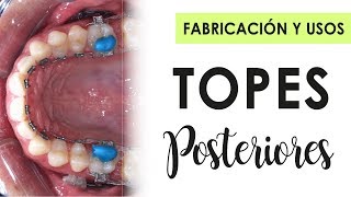 TOPES POSTERIORES | ¿Qué son, ¿Para qúe son, ¿Cómo se fabrican