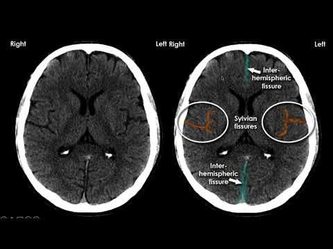 Neuroanatomia Básica na Tomografia de Crânio