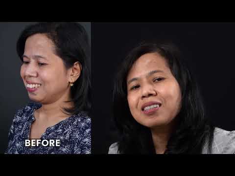 How it feels after Smile Designing Treatment | Smile Designing Hyderabad | Dr Jaydev Dental Clinic