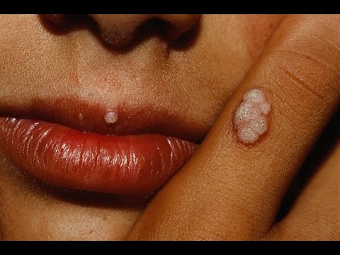HPV fertőzés a szájban - Orvos válaszol - Alsó ajak papilloma