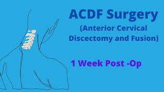 ACDF Surgery Diary-1 week post op-Honest discussion of outcome so far