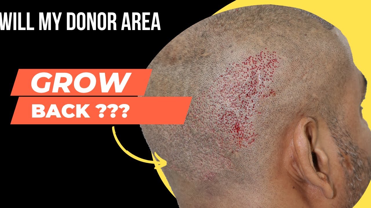 Donor Area Recovery After Hair Transplant || Fue Donor Area In Hair Transplant