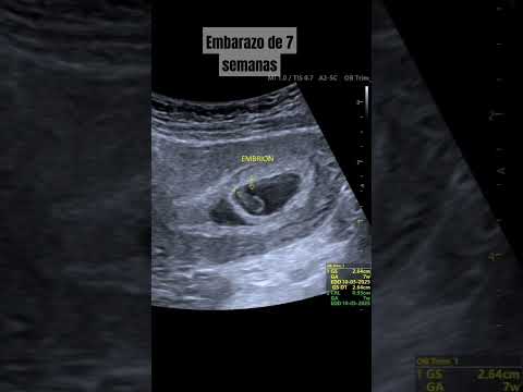 7 weeks pregnant, baby due May 10, 2025