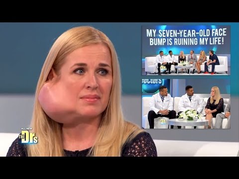 Parotid Tumor Surgery on The Doctors TV Show Changed My Life (Surgeon: Dr. Ryan Osborne)