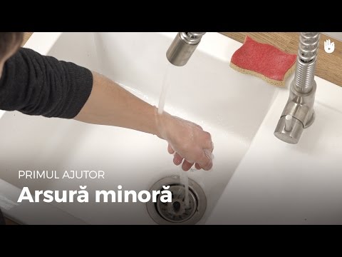 Aflați gesturile de prim ajutor - Arsură minoră