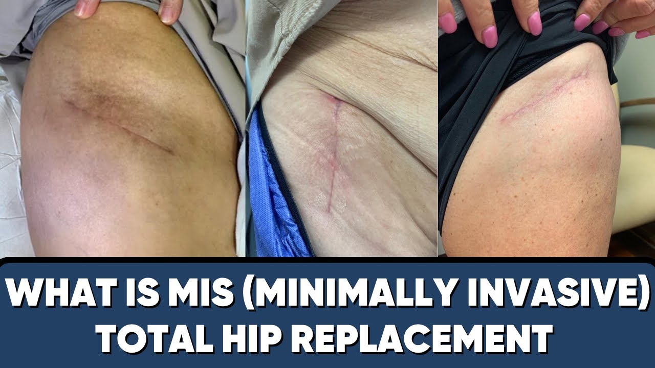 What Is MIS THR? (Minimally Invasive Total Hip Replacement)