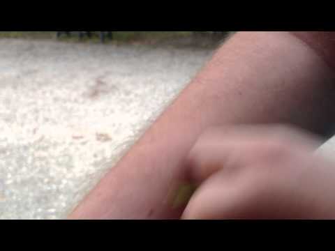 comment soulager piqures de moustiques