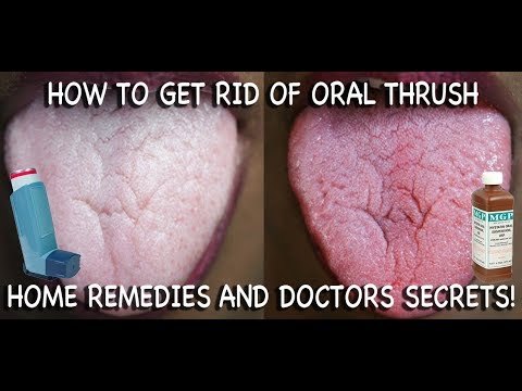 What does oral thrush look like in adults?
