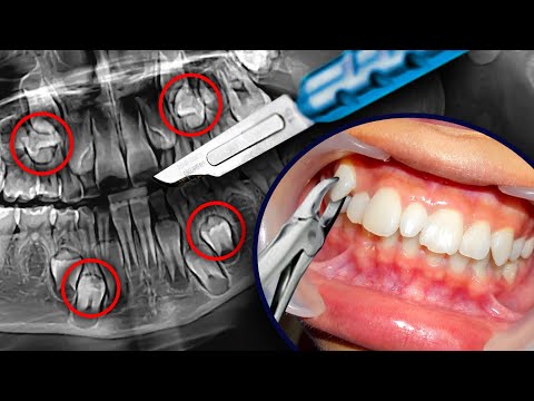 What to do if you have EXTRA TEETH... Orthodontist Explains