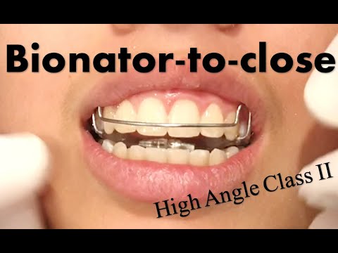 Bionator Retainer- Closing Open Bites