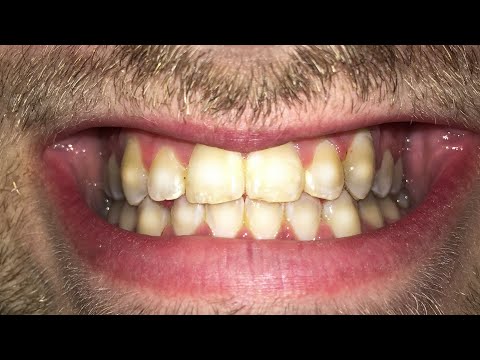 download lagu mp3 mp4 Can You Smoke With Braces, download lagu Can You Smoke With Braces gratis, unduh video klip Can You Smoke With Braces